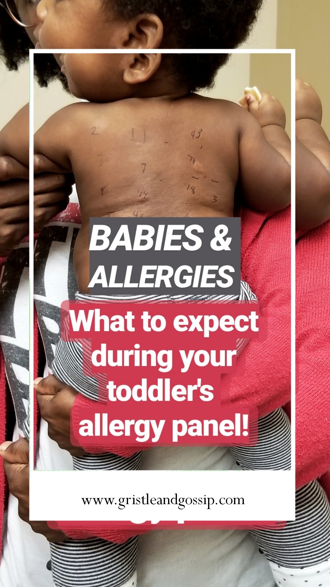 Allergy Testing for Children and Infants with Eczema | Could your breast milk be to blame?