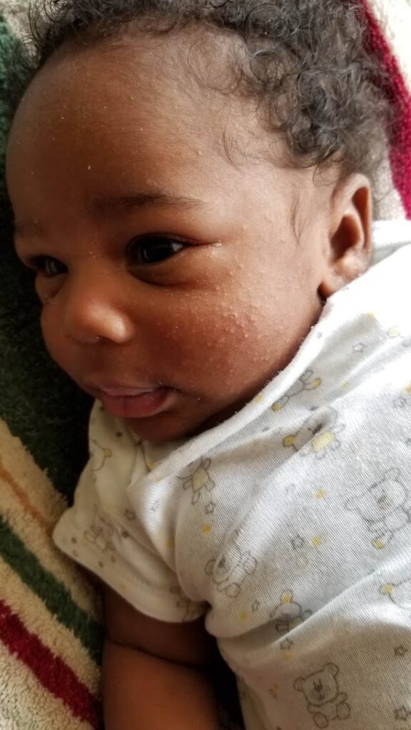 eczema black baby