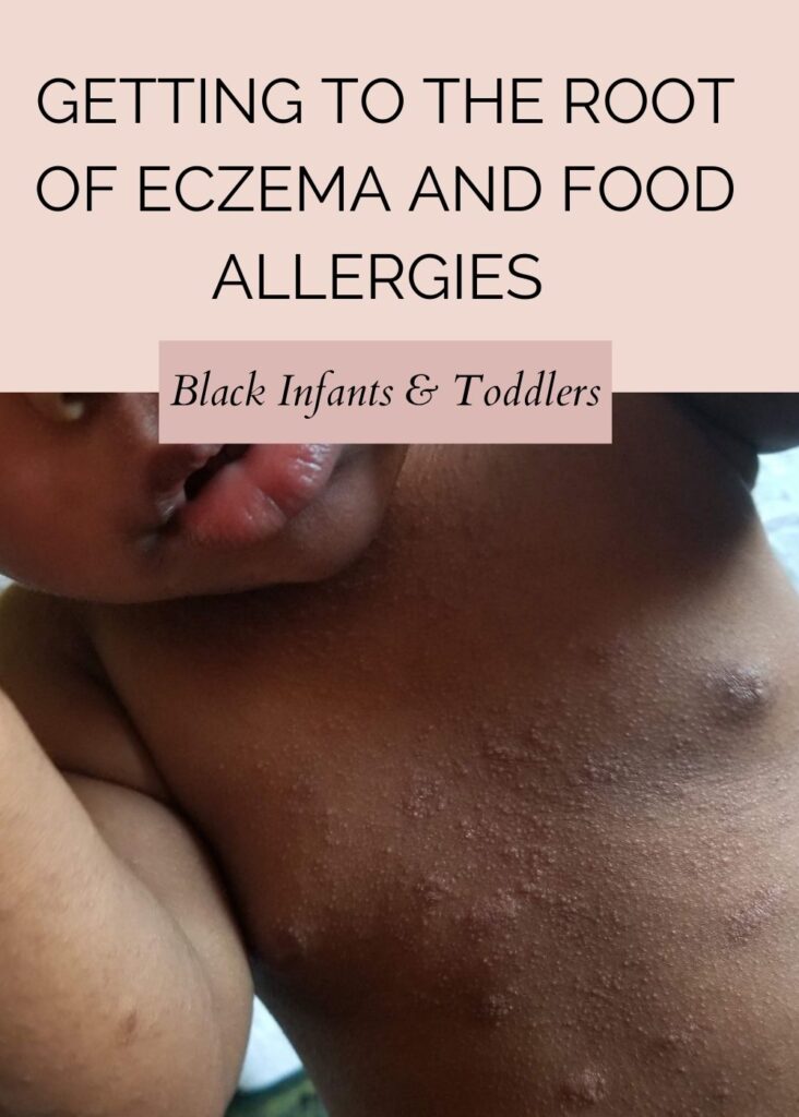 Food Allergies and Eczema in Infants and Toddlers